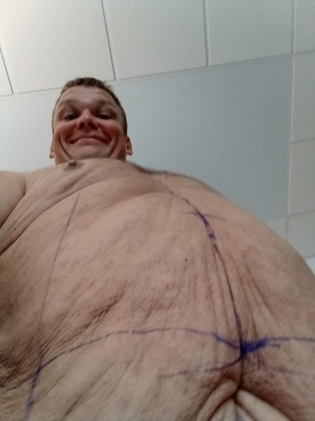 Andrej Baláž absolvoval po Extrémnych premenách úspešnú operáciu odstránenia nadbytku kože.