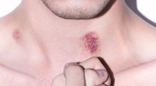 Cucflek na krku: Tieto veci vám pomôžu zbaviť sa ho