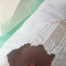 Sarah Hood po uštipnutí pavúkom