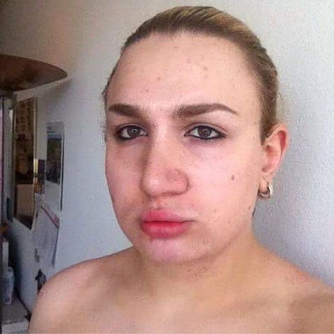 Ivana Vladislava pred odstránením silikónu.