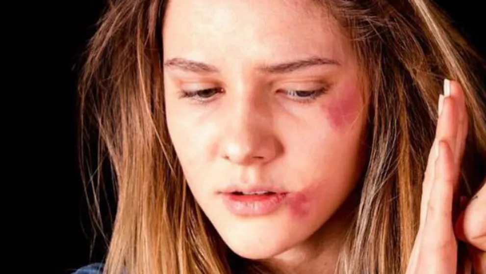 Hazal z Vymenených životov šokuje: Zbitá s monoklom pod okom!