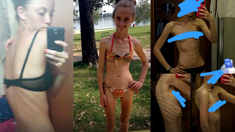Mala 14 a vážila 29 kíl. Posadnutosť chudnutím ich priviedla na psychiatriu